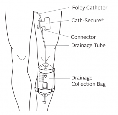 What Does a Foley Catheter Connected to a Leg Bag Look Like?