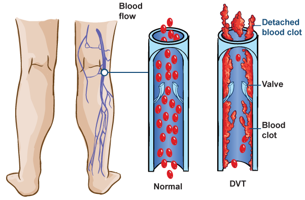 DVT Deep Vein Thrombosis Diagram for T.E.D. Anti-Embolism Stockings