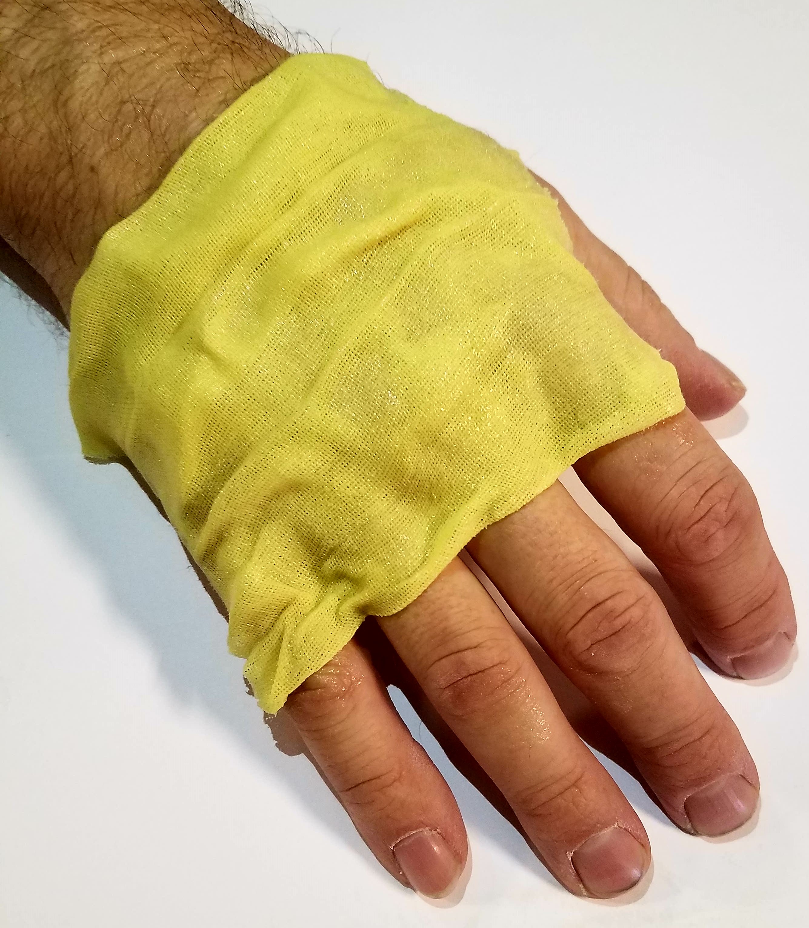 Xeroform - Sterile Petrolatum Gauze Dressing Directly Against Hand of Patient