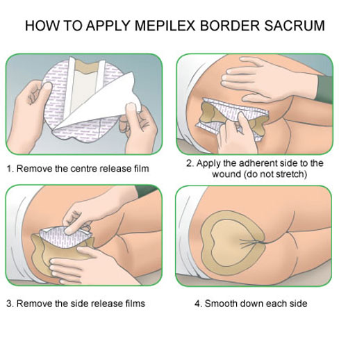 How to Use and Apply Mepilex Border Sacrum Dressings