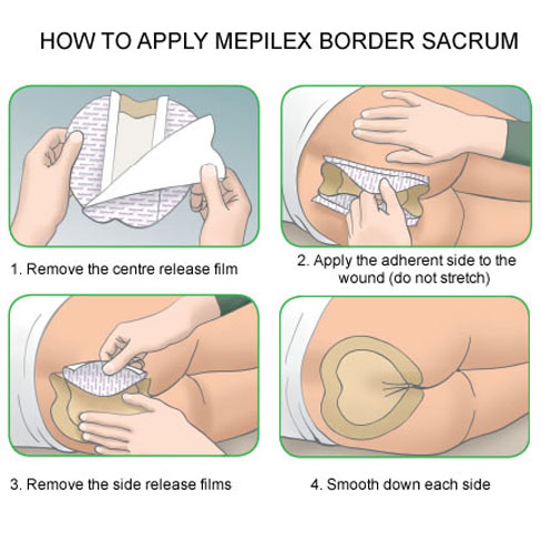 Sacrum Padding Sacrum And Coccyx Wounds