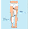Picture of Urocare Fitz-All - Fabric Leg Bag Straps with Buttons