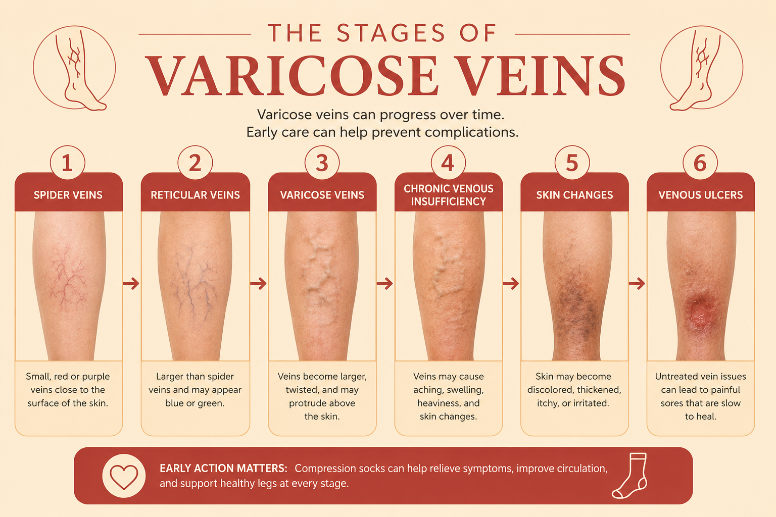 StagesofVaricoseVeinsBlogImage