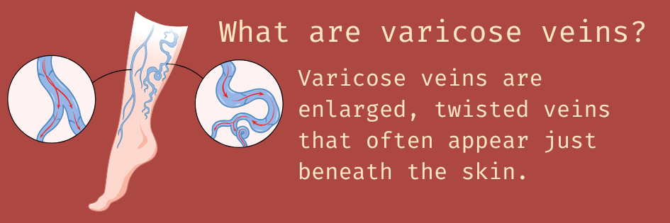 WhatAreVaricoseVeinsImageForBlog